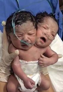 连体婴儿照片,生命相连，共赴人生旅程